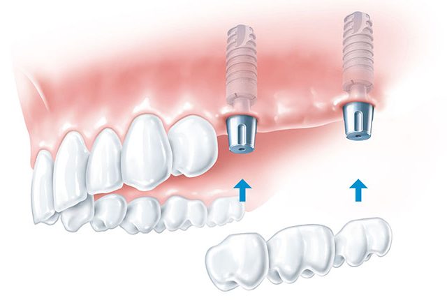 An example of a porcelain fixed bridge going over dental implants in the upper maxillary teeth.