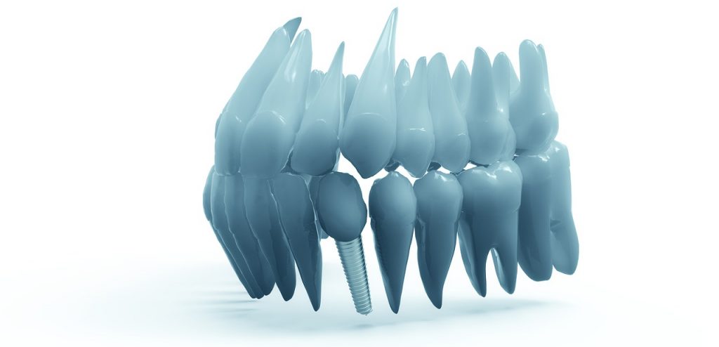 An example of a dental implant blending in with the rest of the dentition.
