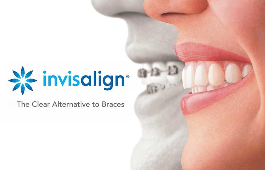 Invisalign, the clear alternative to braces