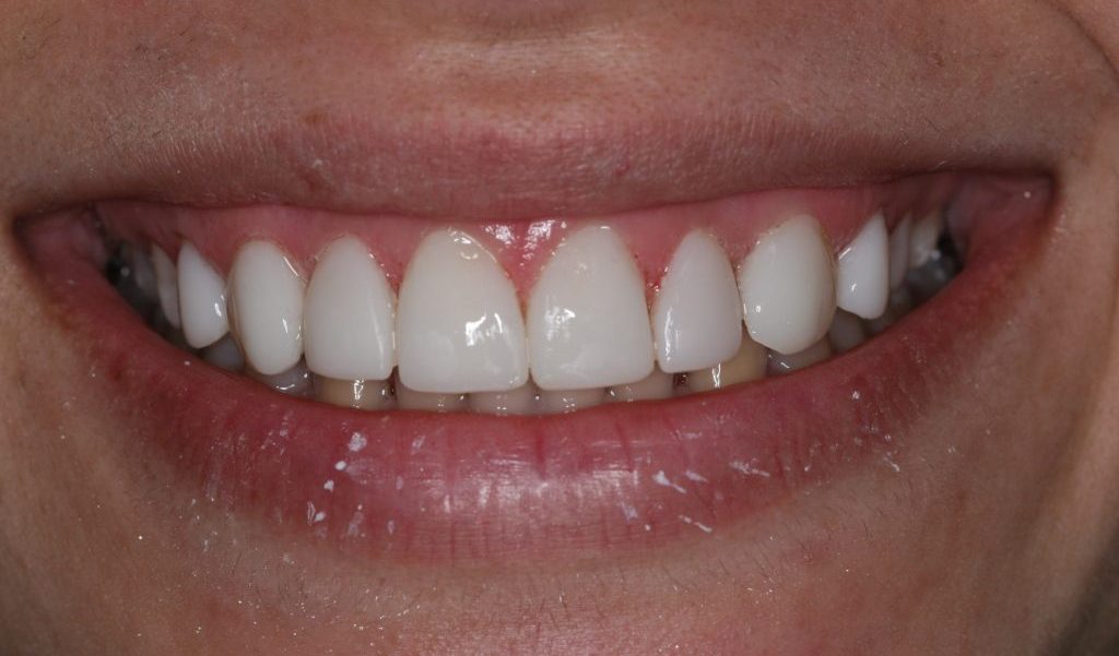 Patient 2 after restorative and cosmetic procedures were performed