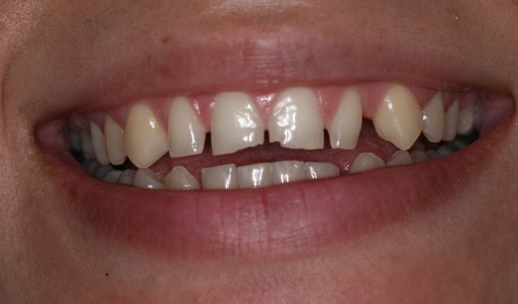 Patient 2 before restorative and cosmetic procedures were performed