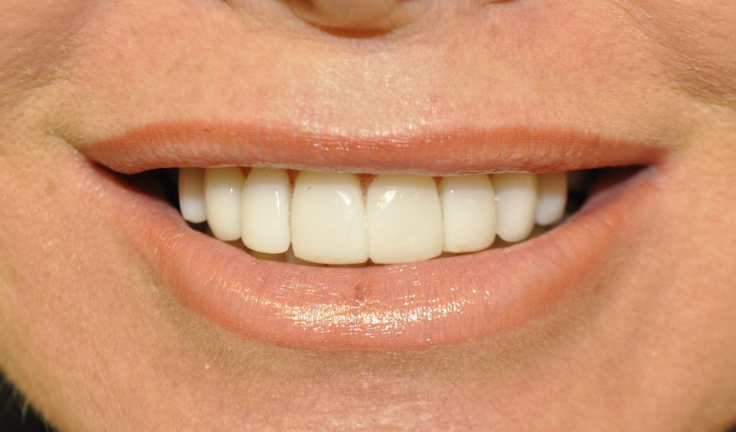 Patient 6 after restorative and cosmetic procedures were performed