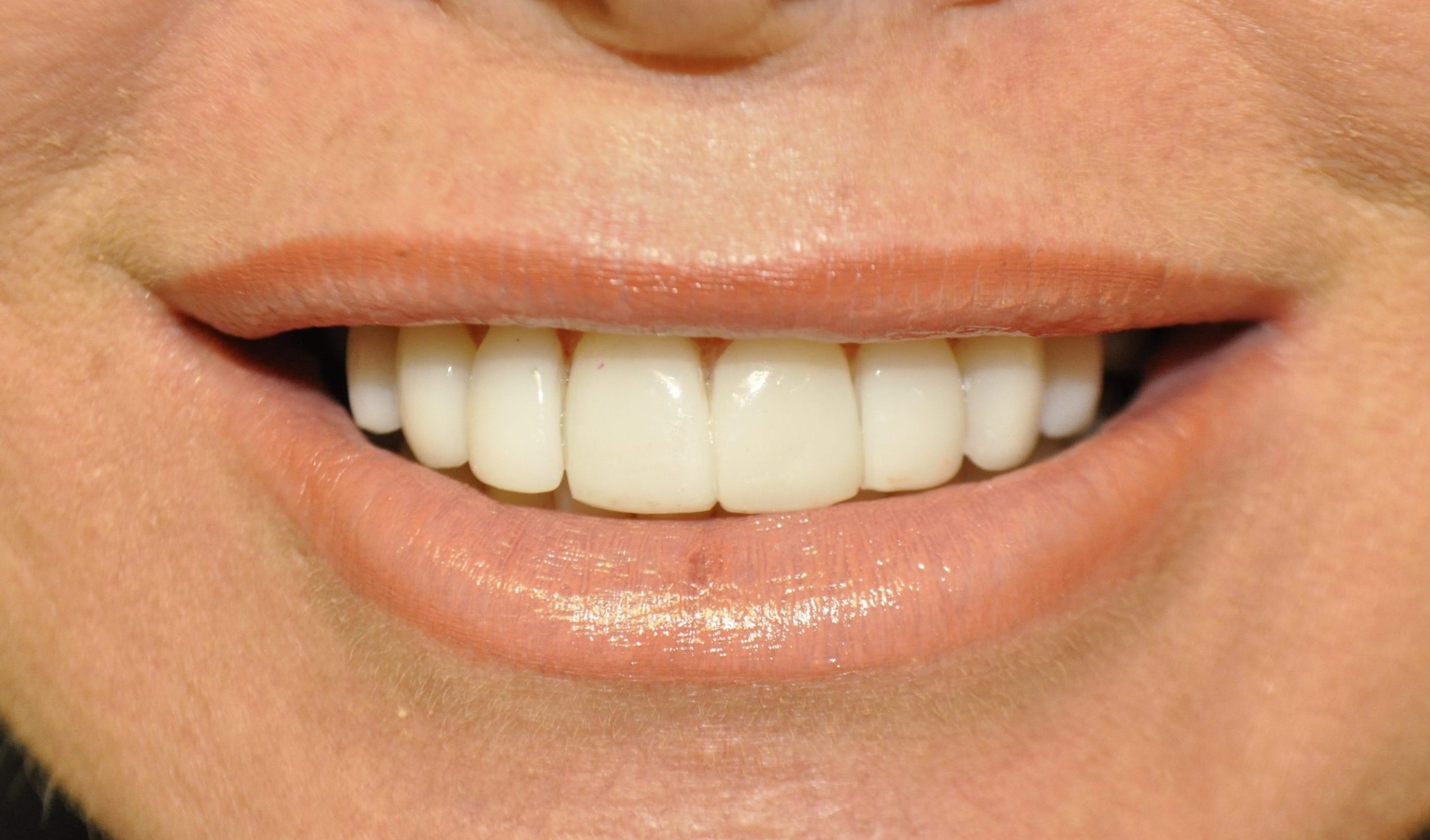 Patient 3 after restorative and cosmetic procedures were performed