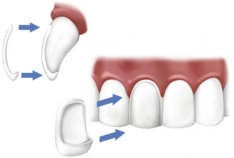 An example of a veneers procedure.